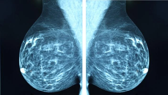 X-ray Mammogram